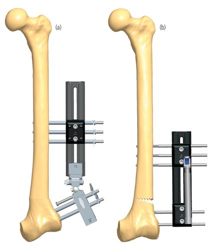 Deformity Correction Surgery
